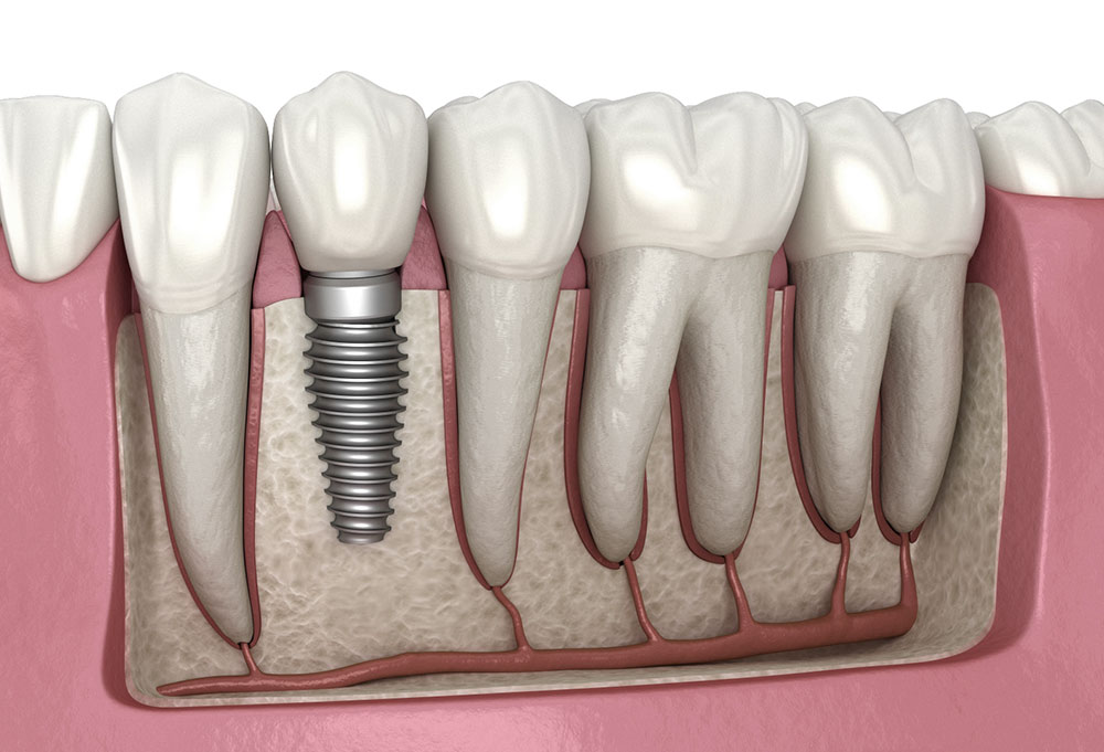 L'implantologia: rimettere i denti sull'osso giusto.