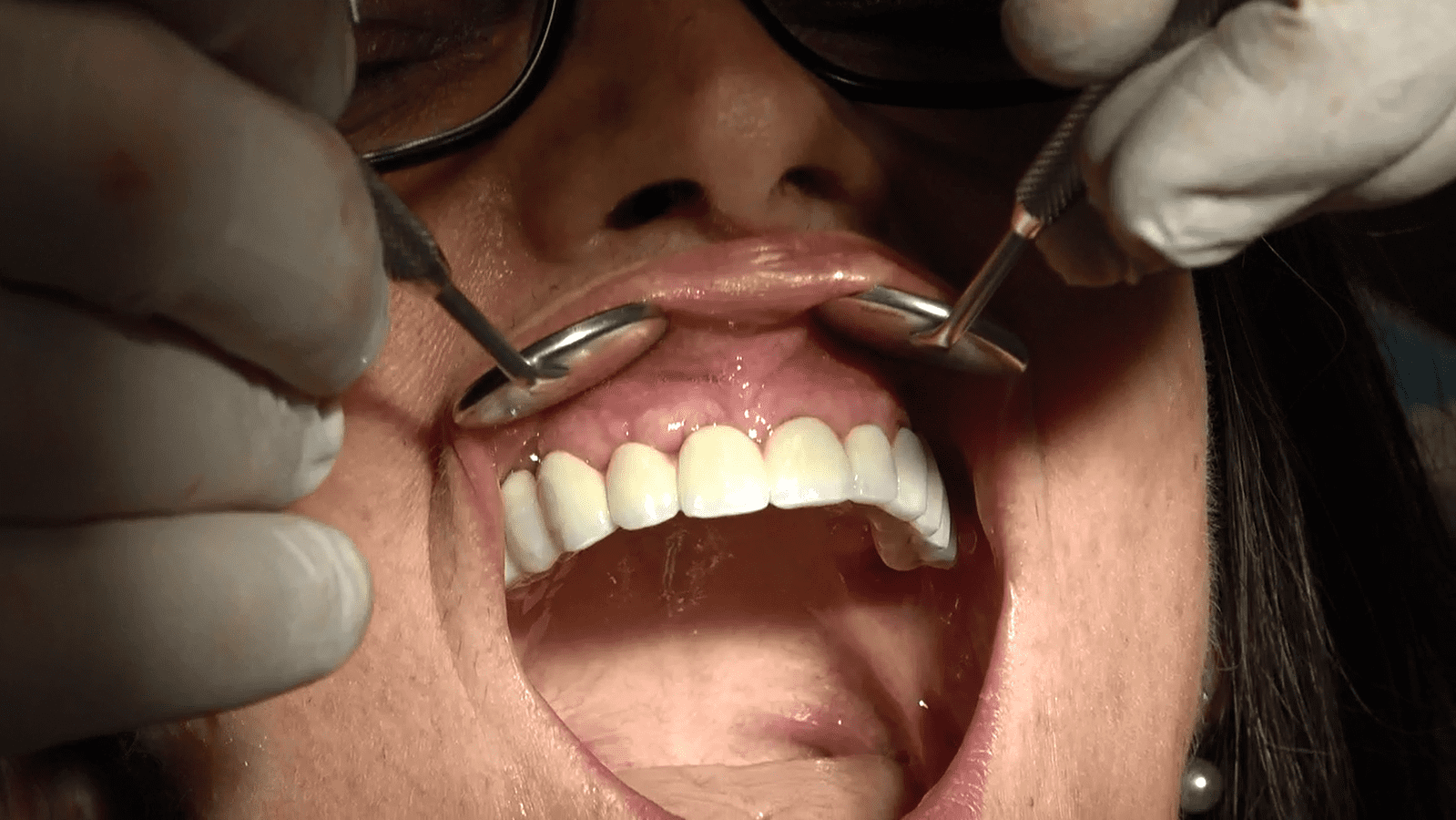 Implantologia senza osso a carico immediato possibile solo con Bilateral sinus solution ALLONFULL BSS