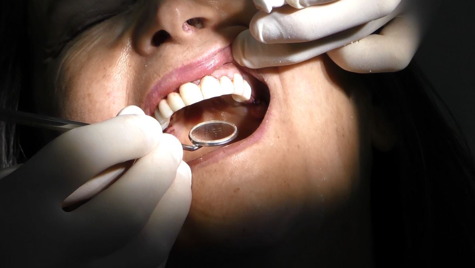 Implantologia senza osso a carico immediato possibile solo con Bilateral sinus solution ALLONFULL BSS