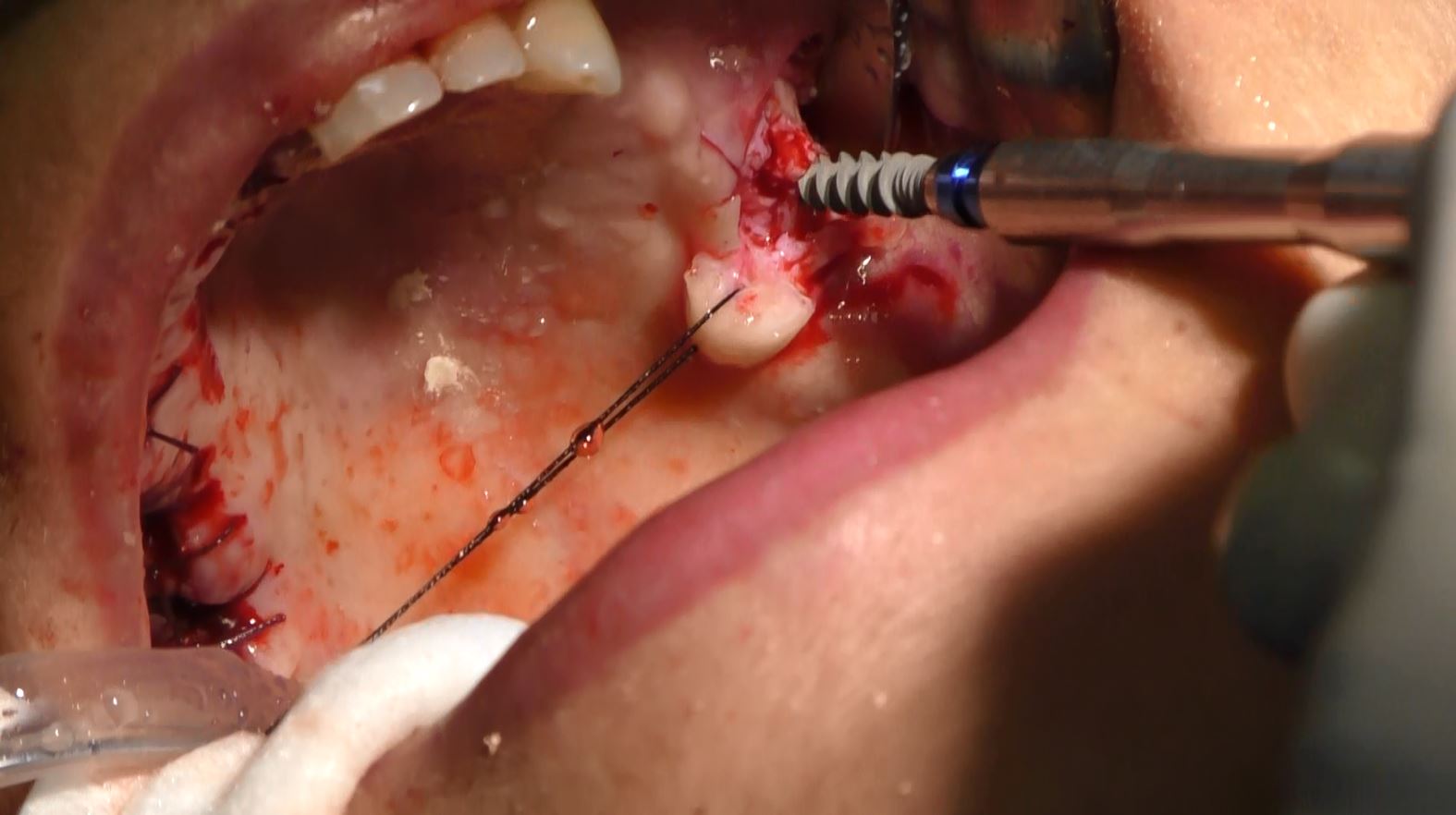 Implantologia senza osso a carico immediato possibile solo con Bilateral sinus solution ALLONFULL BSS