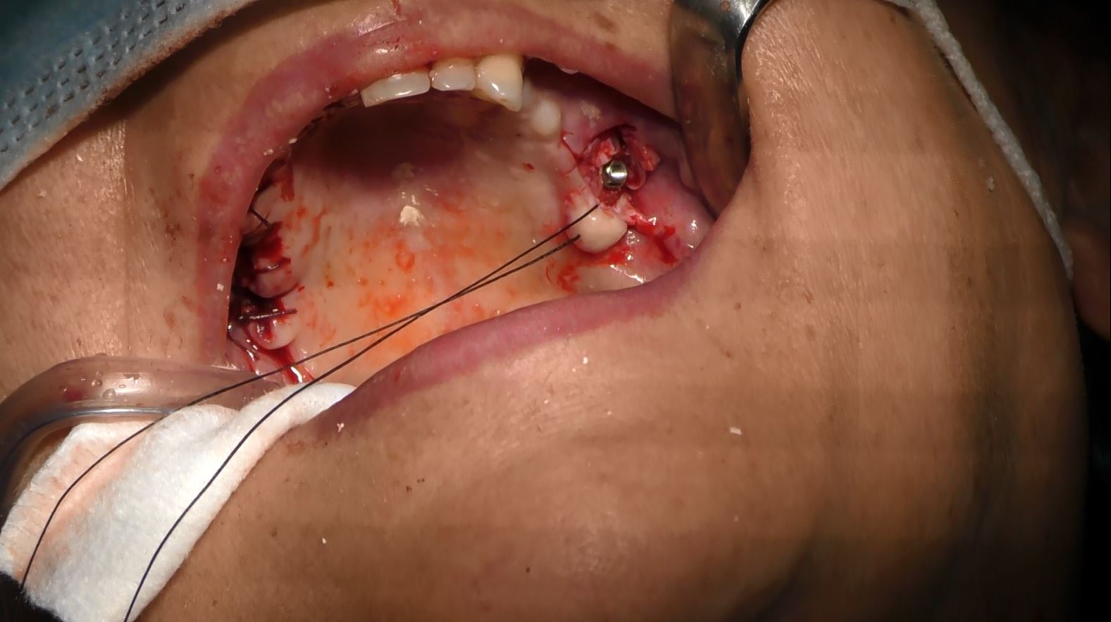 Implantologia senza osso a carico immediato possibile solo con Bilateral sinus solution ALLONFULL BSS