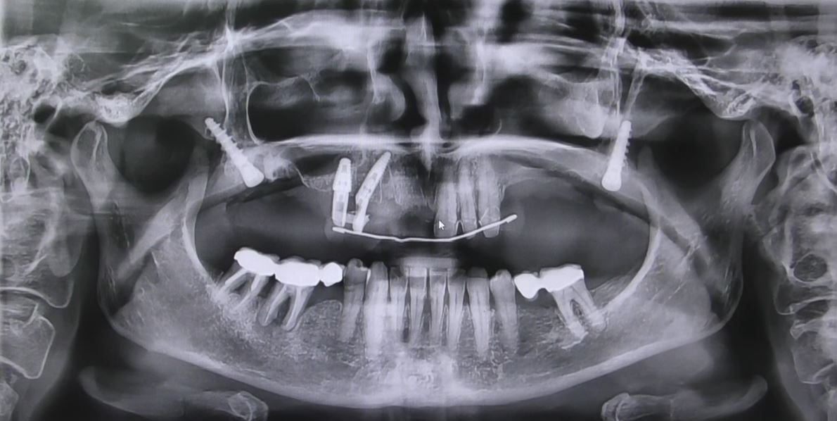 Implantologia senza osso a carico immediato possibile solo con Bilateral sinus solution ALLONFULL BSS