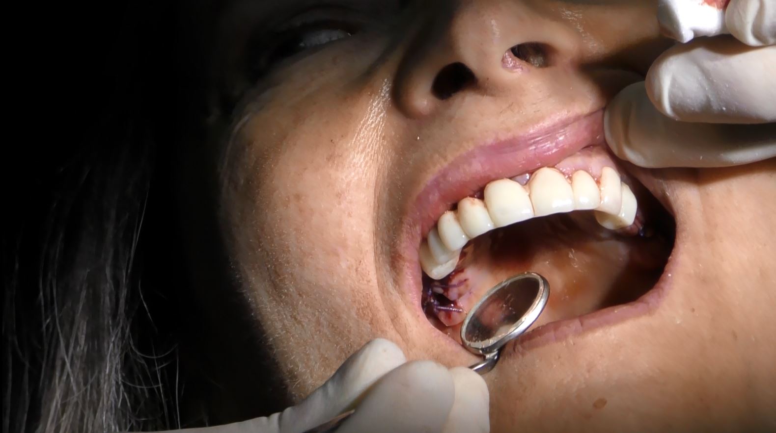 Implantologia senza osso a carico immediato possibile solo con Bilateral sinus solution ALLONFULL BSS