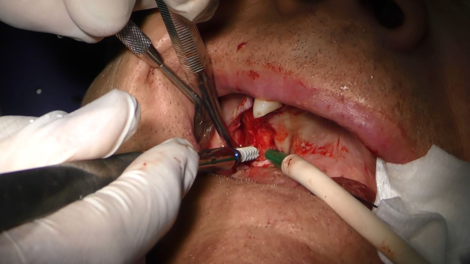 Implantologia Senza Osso Milano – Diagnosi del 98% dei dentisti italiani su un paziente atrofico: “Senza Osso”… Ma Quale Osso Mi Hai Diagnosticato?