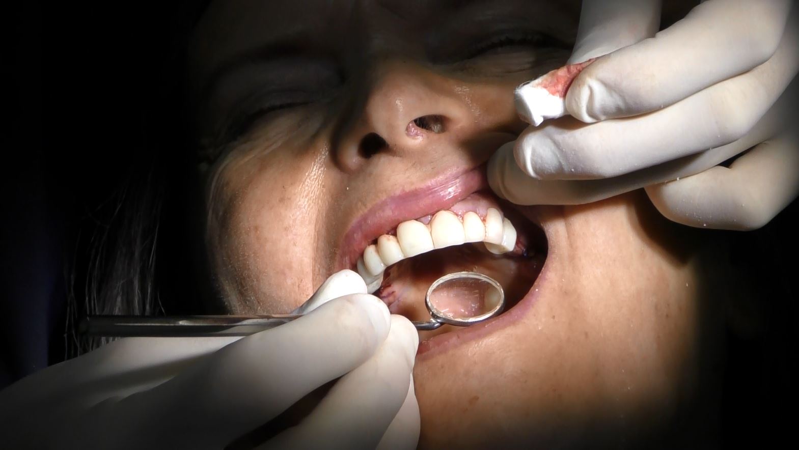 Implantologia senza osso a carico immediato possibile solo con Bilateral sinus solution ALLONFULL BSS
