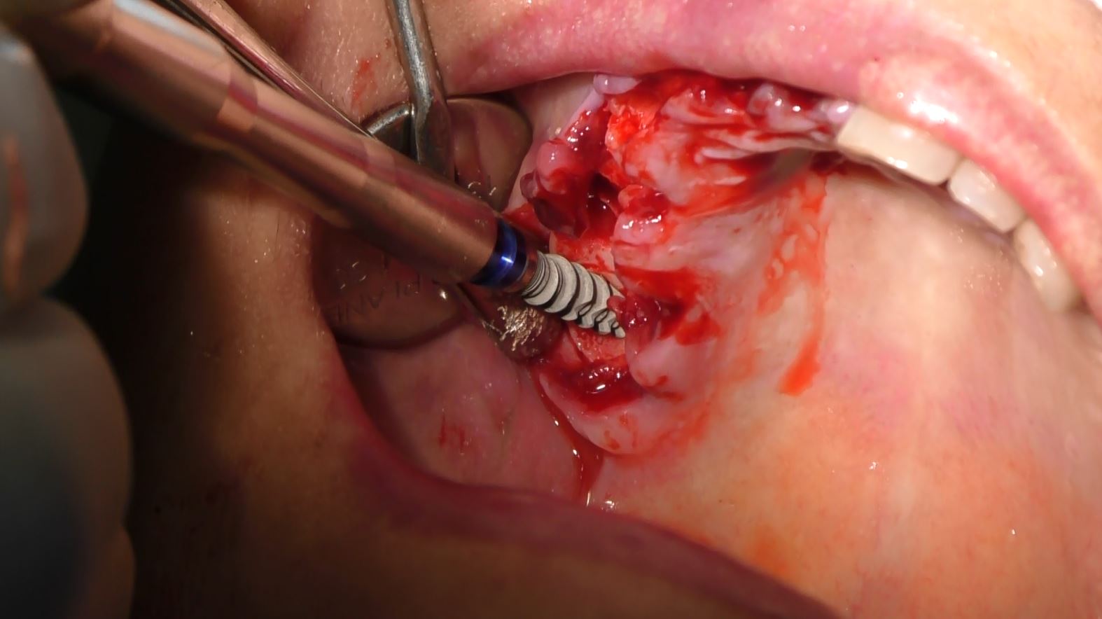 Implantologia senza osso a carico immediato possibile solo con Bilateral sinus solution ALLONFULL BSS