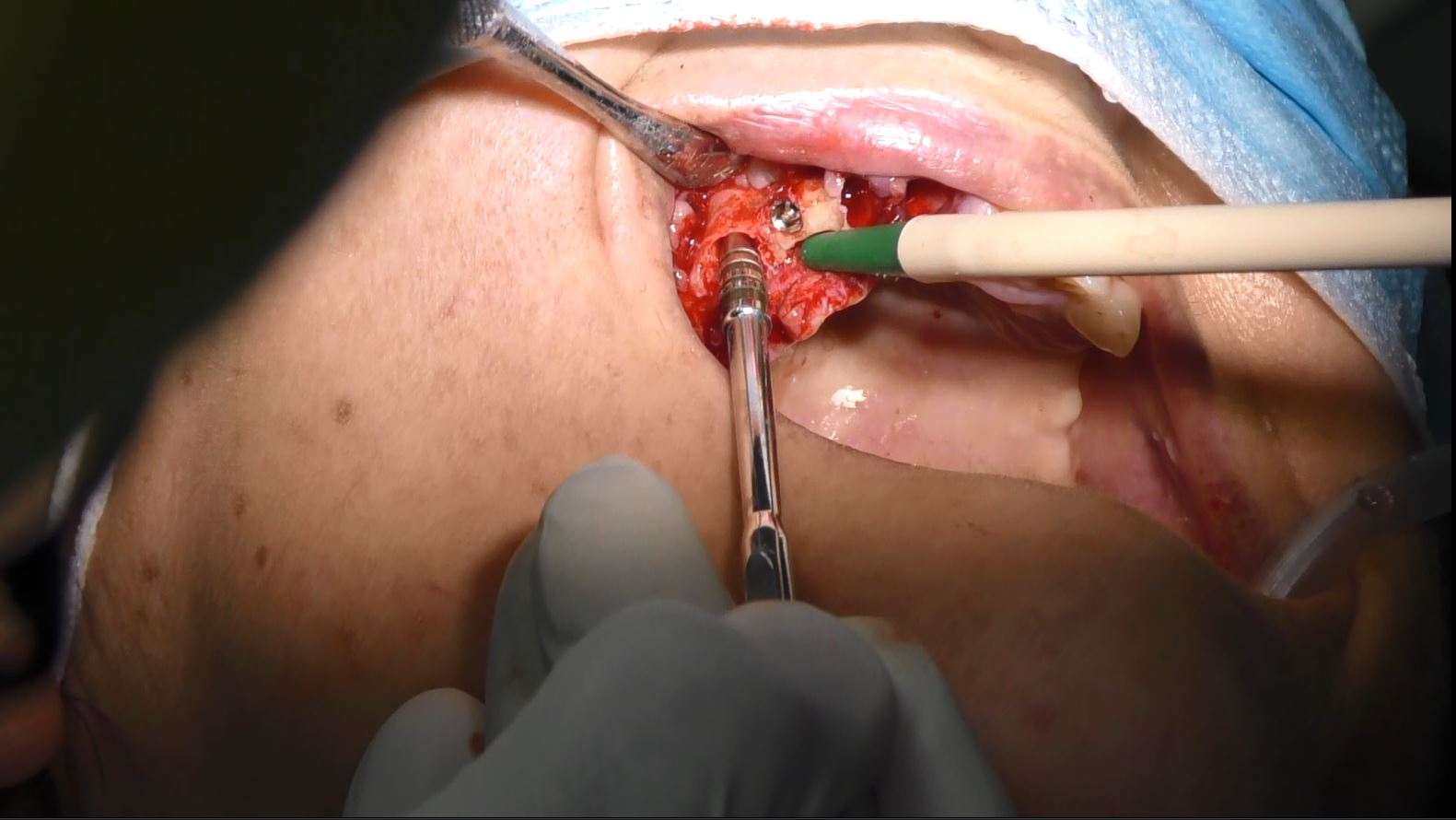 Implantologia senza osso a carico immediato possibile solo con Bilateral sinus solution ALLONFULL BSS
