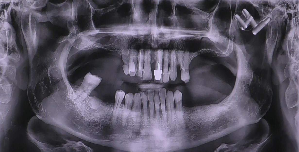 IMPLANTOLOGIA SENZA OSSO MILANO ECCO A VOI LA DIAGNOSI SU QUESTO PAZINTE ATROFICO TOTALE SONE POSTERIORI DEI MASCELLARI SUPERIORE COME SI INTERINE PROGRAMMIAMO UN RIALZO DEIS ENIA MSECLLARI PERCHE QUI COME TUTTI POSSIAMO VEDERE CE UNA GRAVISSIMA ATROOFIA, , INVECE IL PAINTE CHIMA NICOLA LETTERA CHE CON LA ALLONFULL PERCHE ANCORA GIOVANE CON ALLONFULL BSS RISTABILISCE IL PAZINTE EVITA TUTTO E HA UN CARICO IMEMDIATO COSI I APZINTI VEDONO FINALMENTE LA VERITA CHE POSNO ESSERE RIABILITATI CON DENTI FISSI IN 2 ORE E NON ANNO BISOGNO DI NULALA SOLO DELLA VERITA E DI MEDIC CHE FACCIANO I MEDICI
