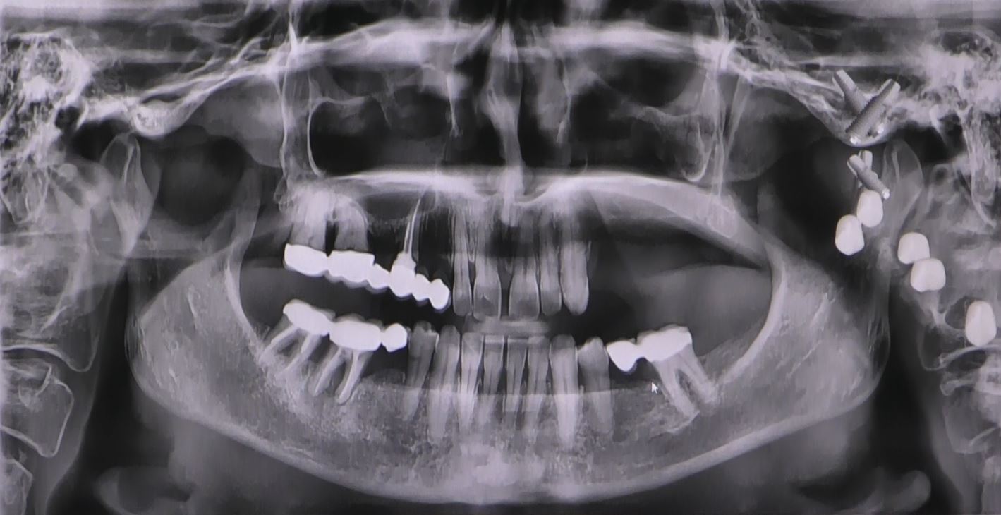 Implantologia senza osso a carico immediato possibile solo con Bilateral sinus solution ALLONFULL BSS